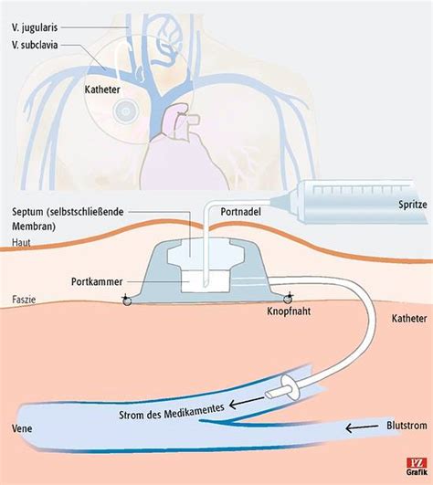 port nicht rückläufig|Patienteninformation i.v. Port Implantation